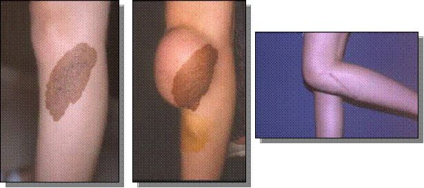 ablation-d-un-naevus-du-genou-par-expansion-cutanee-jgtkk