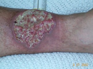 Pyoderma gangrenosum